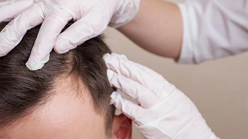 An image of a medical worker examines a man's head for head lice.