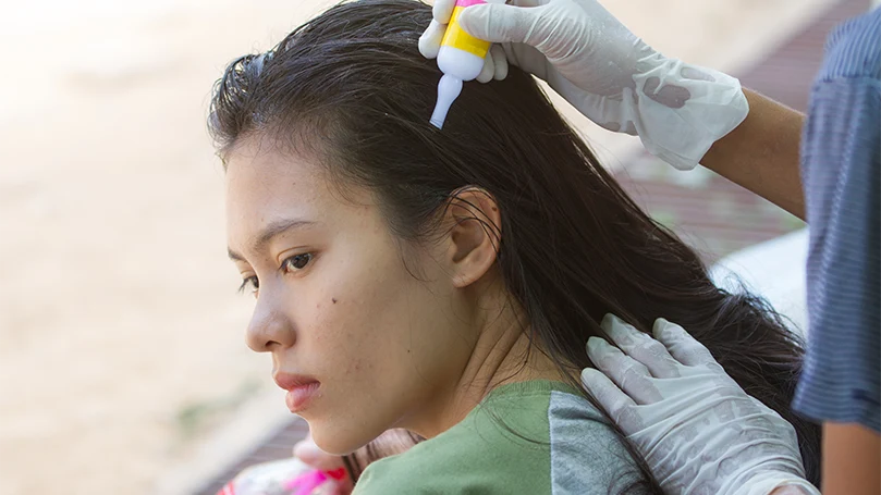 Imagem de uma mulher a utilizar um tratamento contra piolhos no seu cabelo.