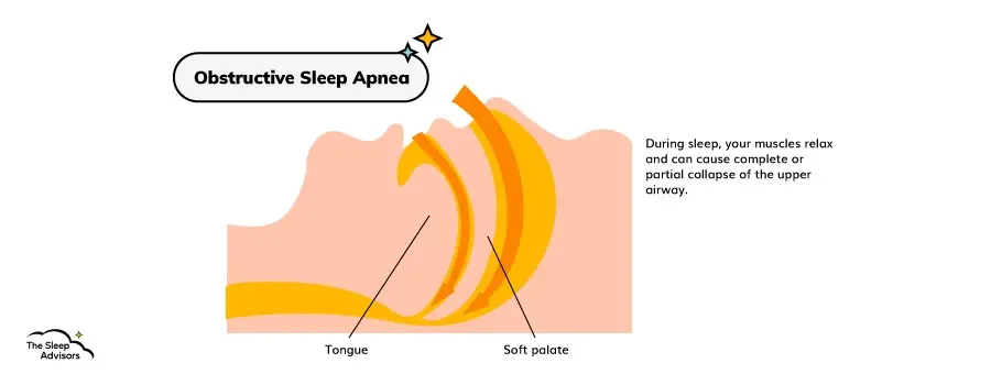 Infografia que mostra como ocorre a Apneia Obstrutiva do Sono